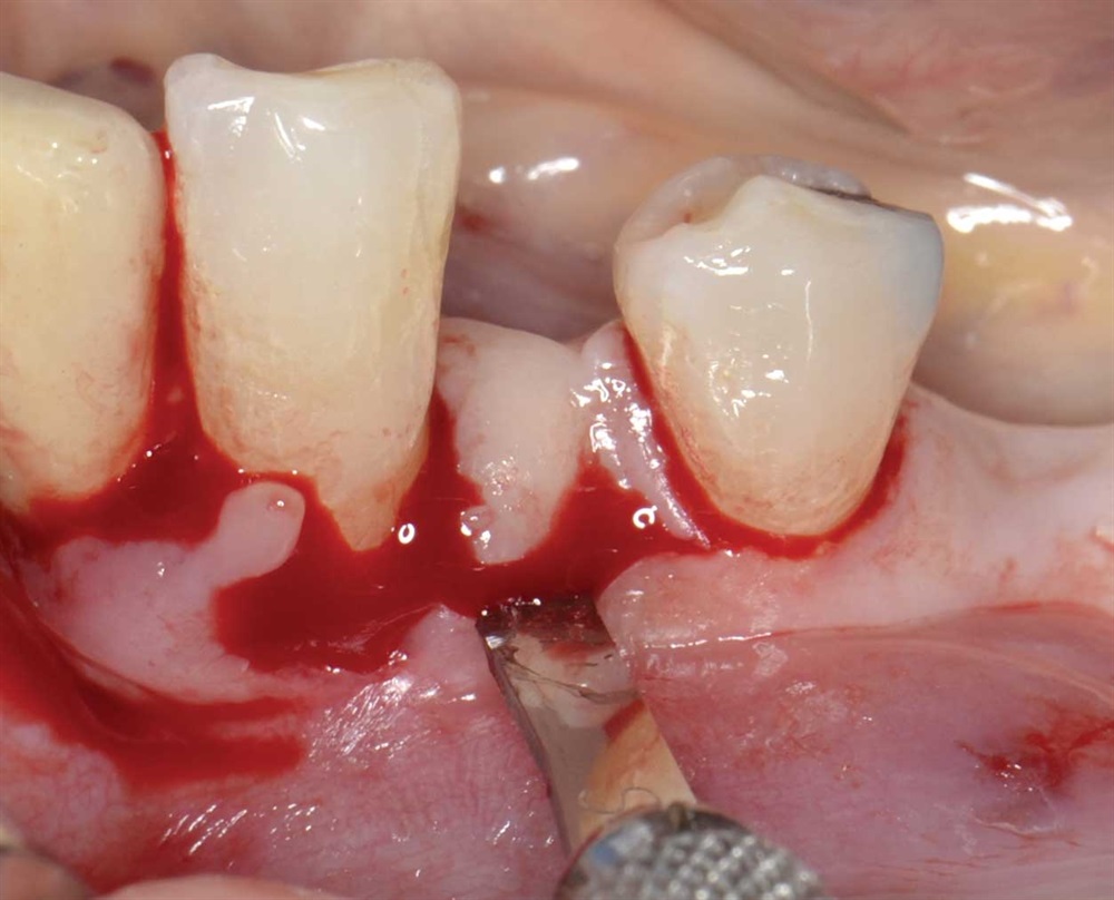 Tarquini_Periodontal intrabony defect